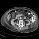 Hematoma after renal biopsy: CT - Computed tomography
